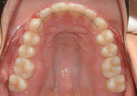 ortodoncija retencija